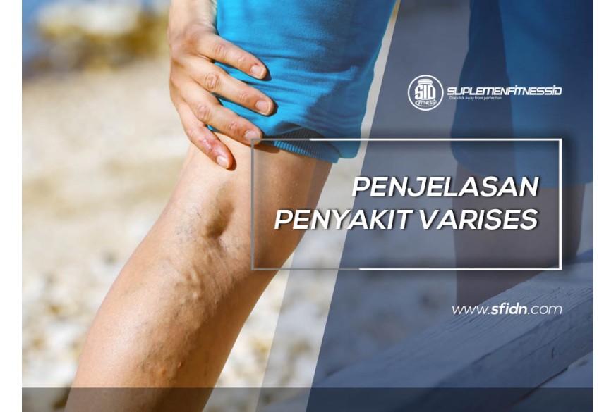 sfidn - Penjelasan Lengkap Penyakit Varises