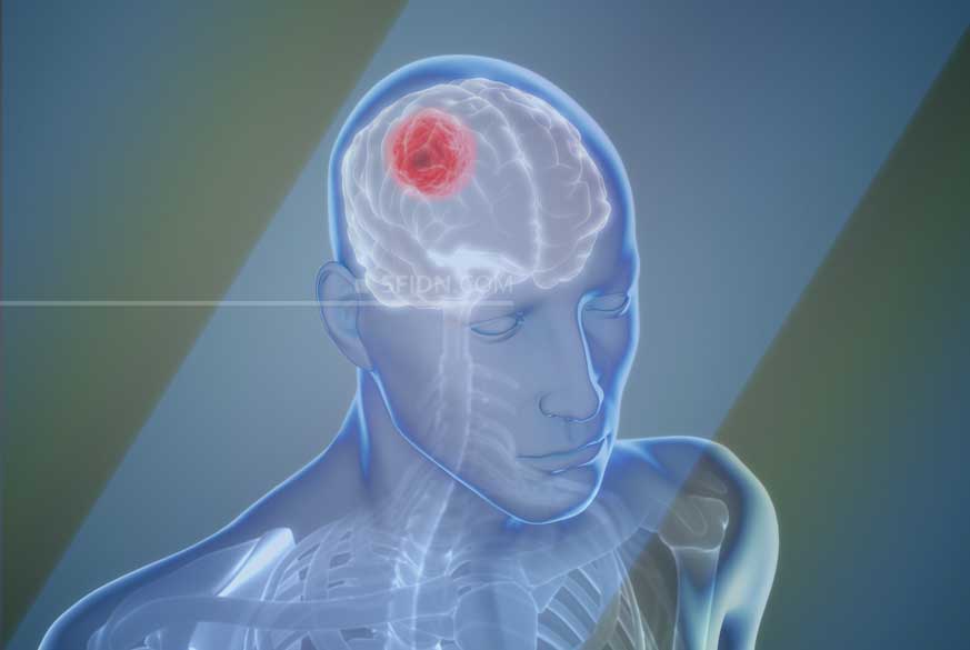 sfidn - Mengenal Glioblastoma, Kanker Otak yang Menyerang Agung Hercules