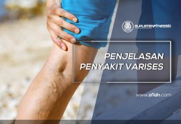 Penjelasan Lengkap Penyakit Varises